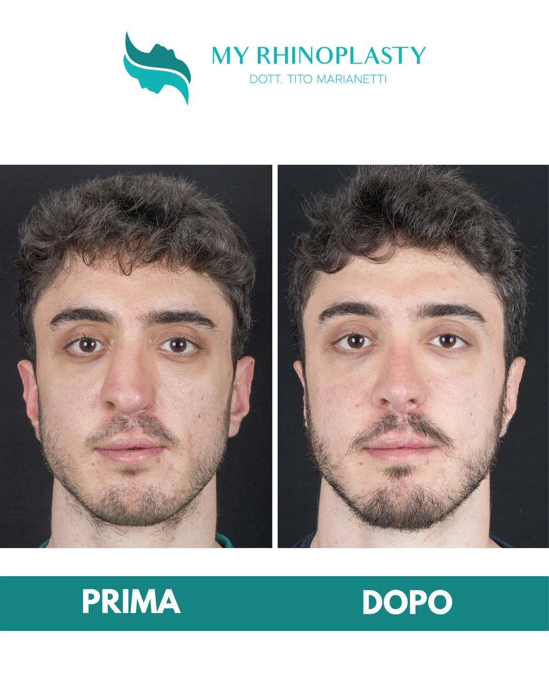 Rinoplastica-di-revisione-1-Francesco
