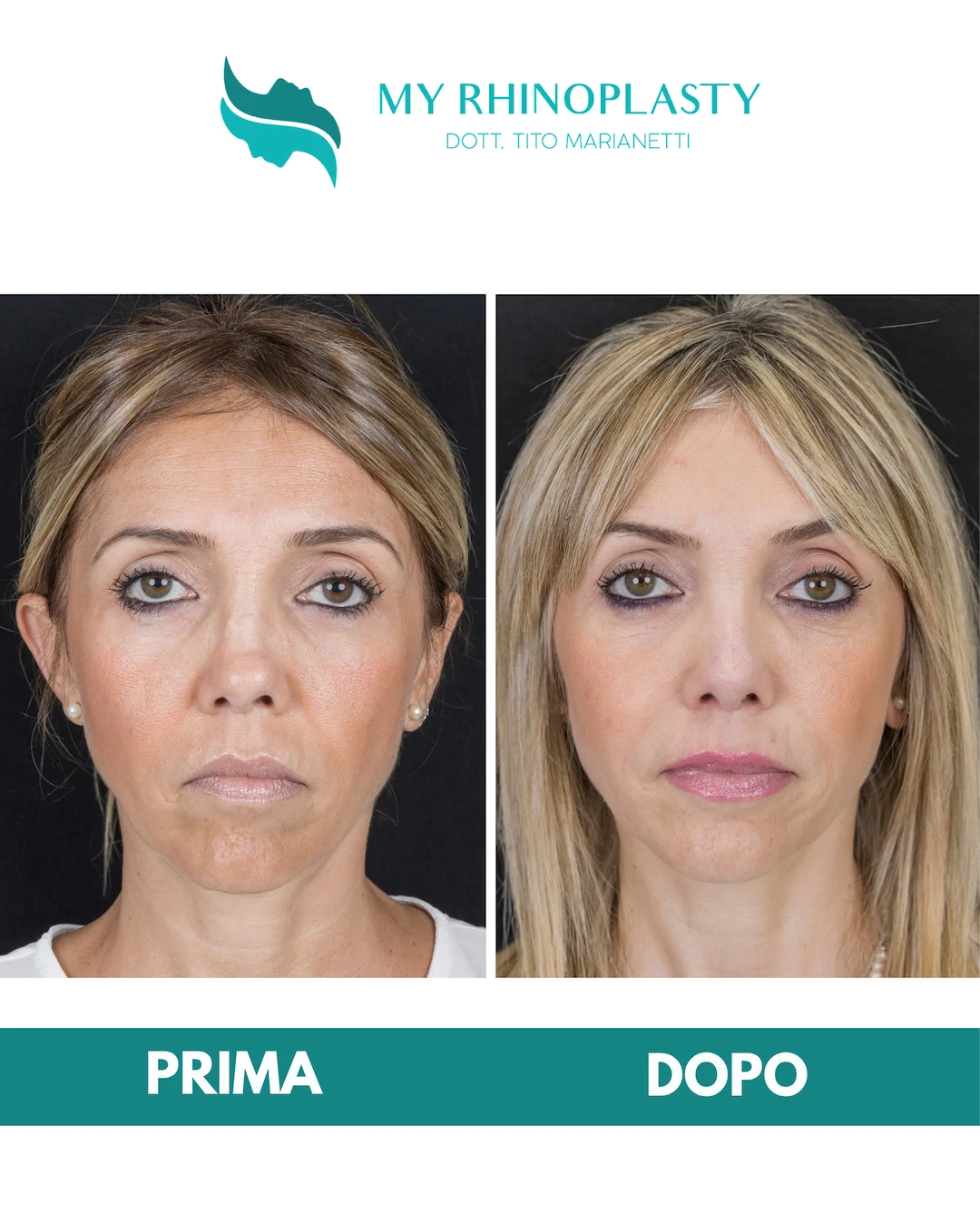 Rinoplastica-di-revisione-1-Maria