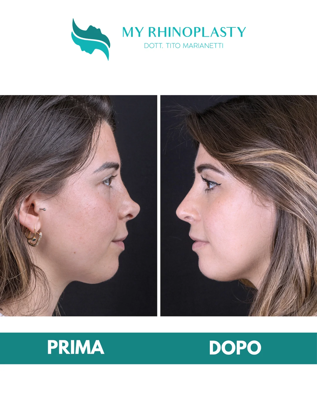 Rinoplastica-di-revisione-2-Annarita