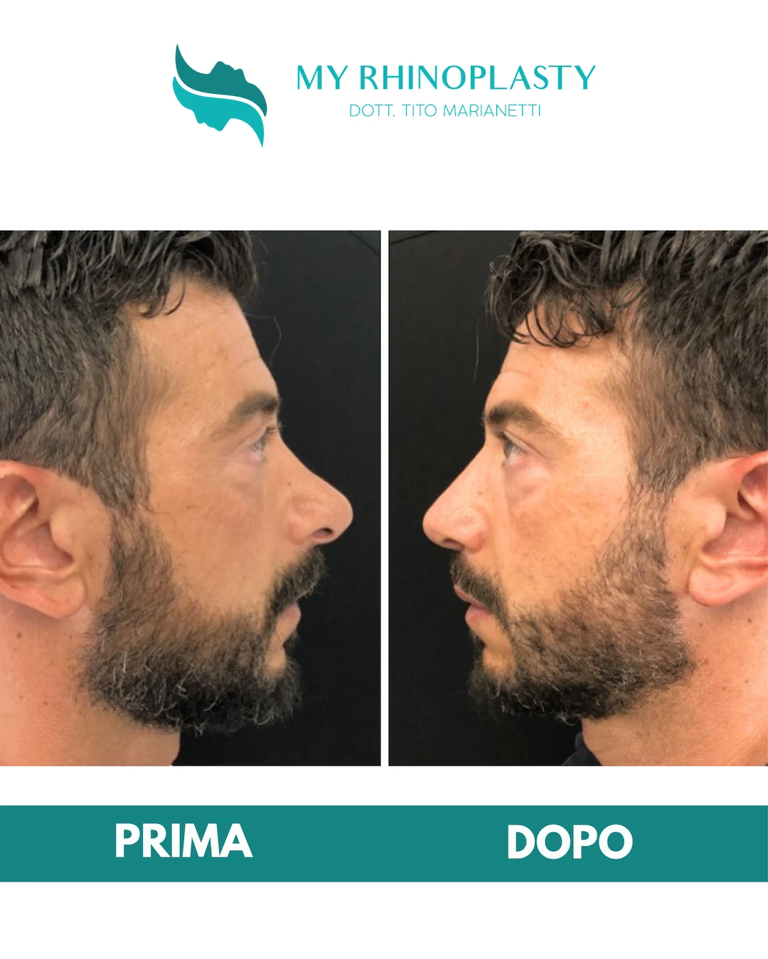 Rinoplastica-di-revisione-2-Cara