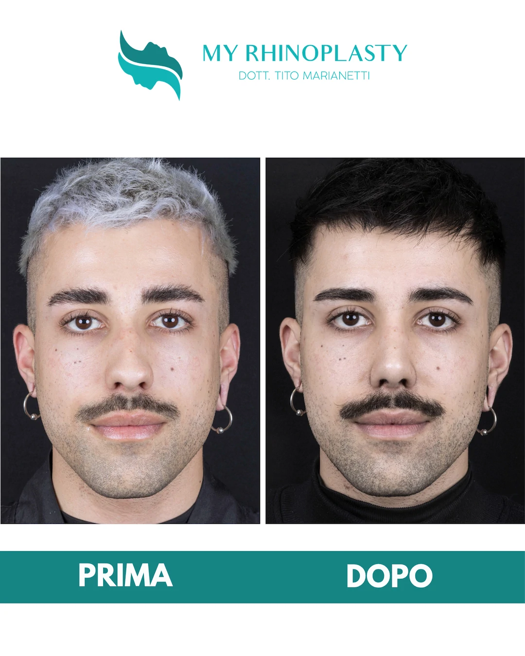 Rinoplastica-primaria 1-Alessandro