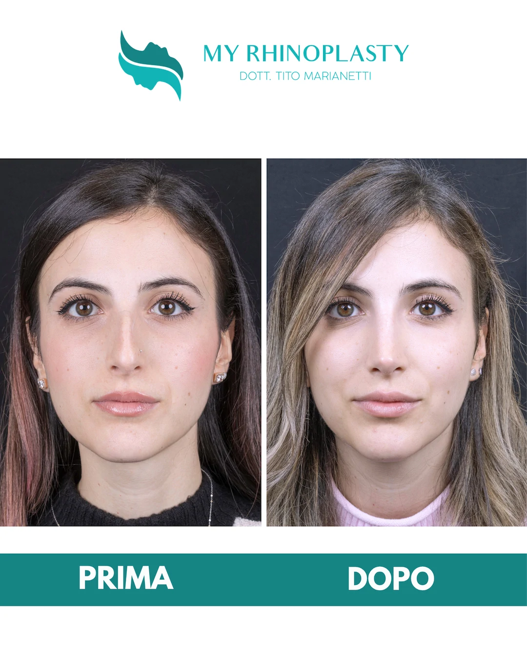 Rinoplastica-primaria 1-Alice