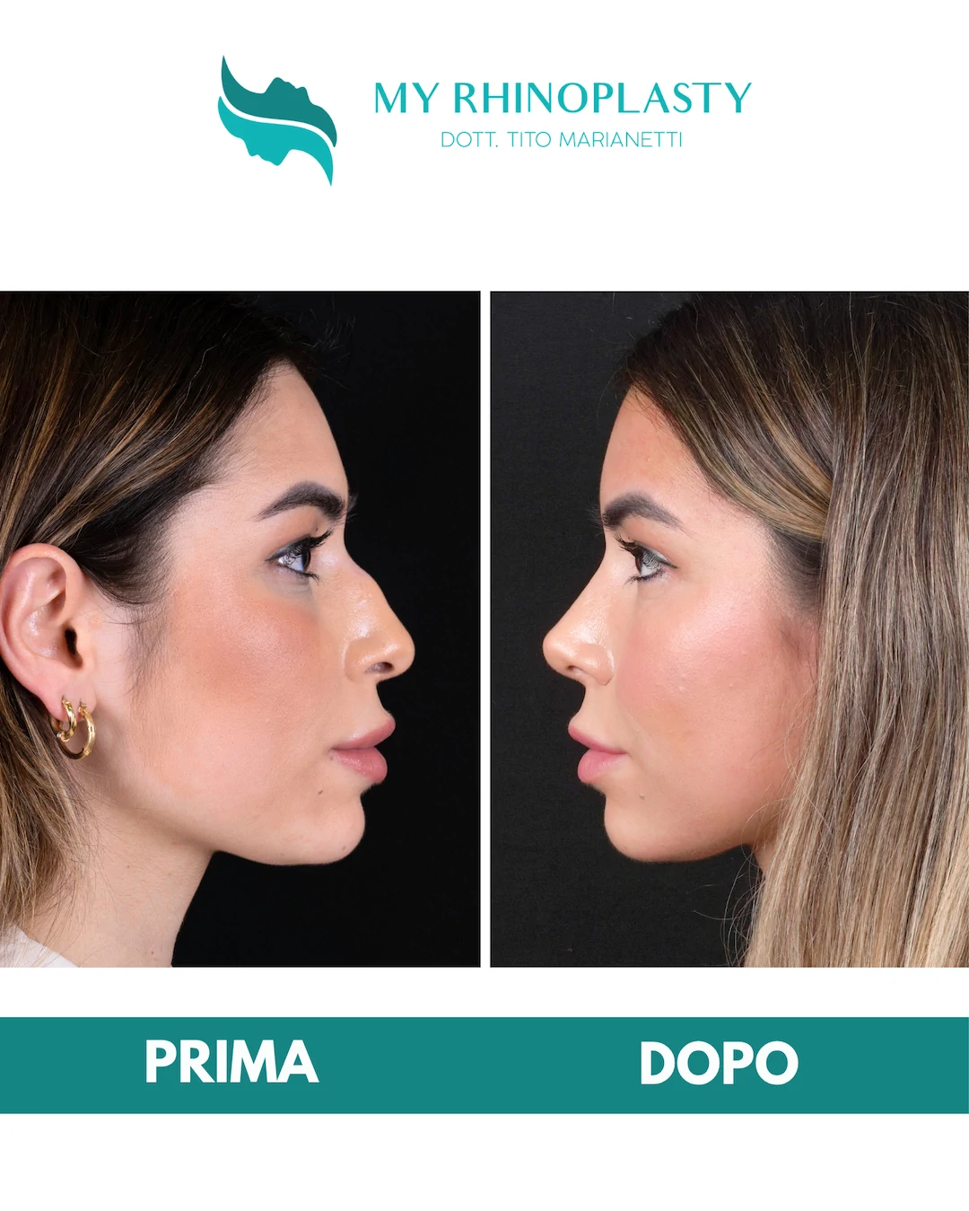 Rinoplastica-primaria 1-Chiara