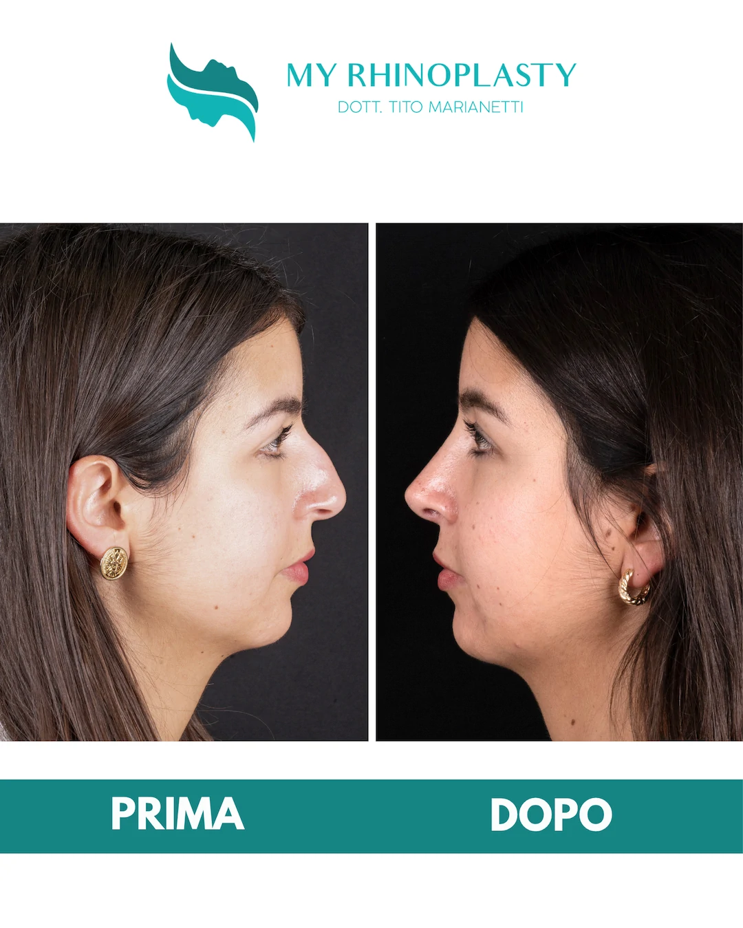 Rinoplastica-primaria 1-Doriana