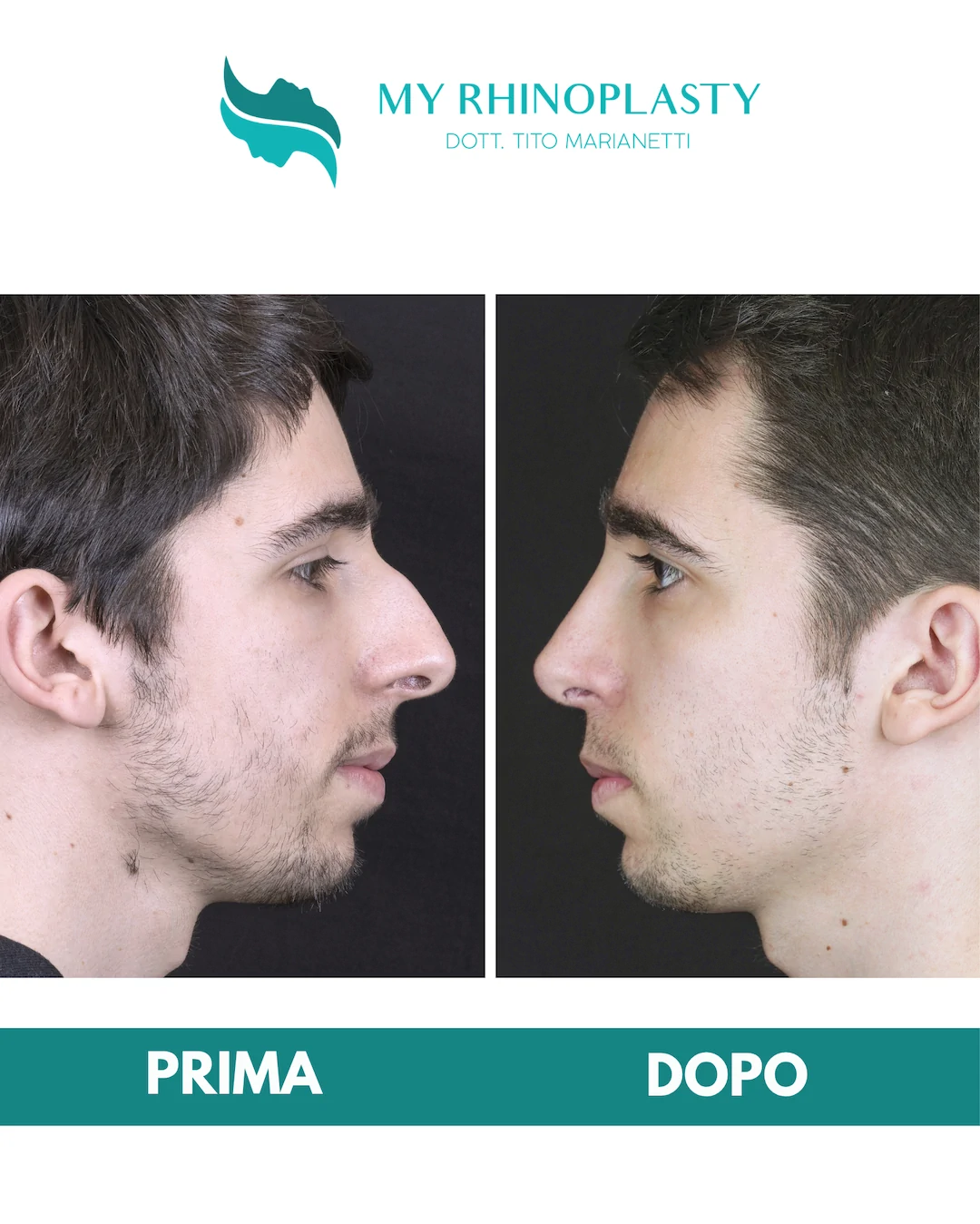 Rinoplastica-primaria 1-Francesco