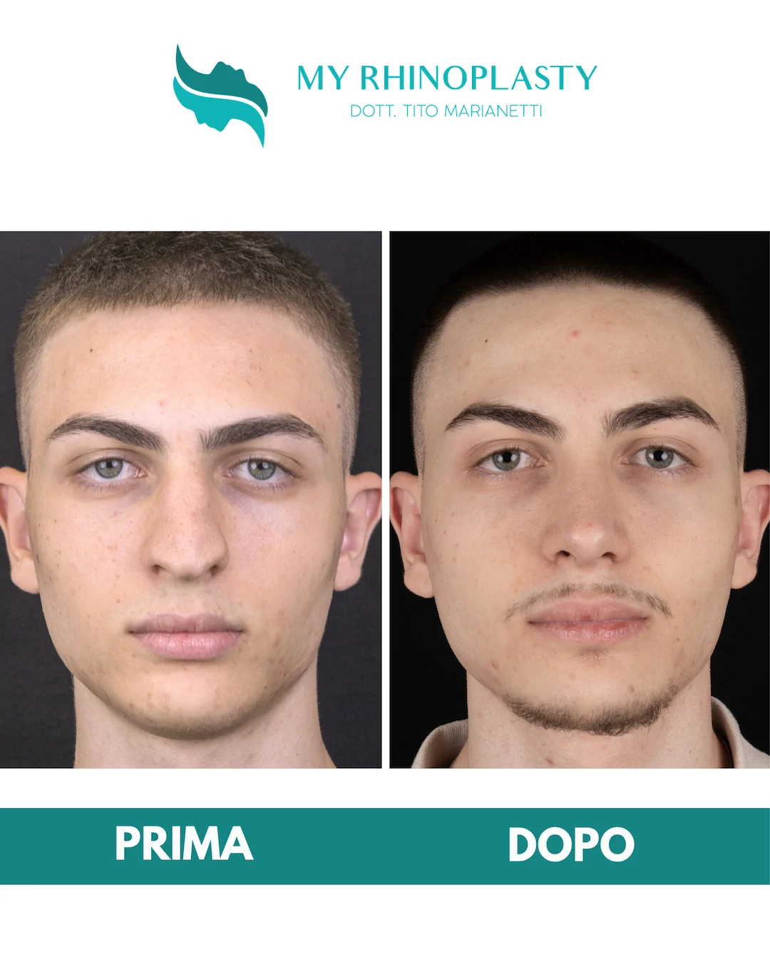 Rinoplastica-primaria 1-Gabriele
