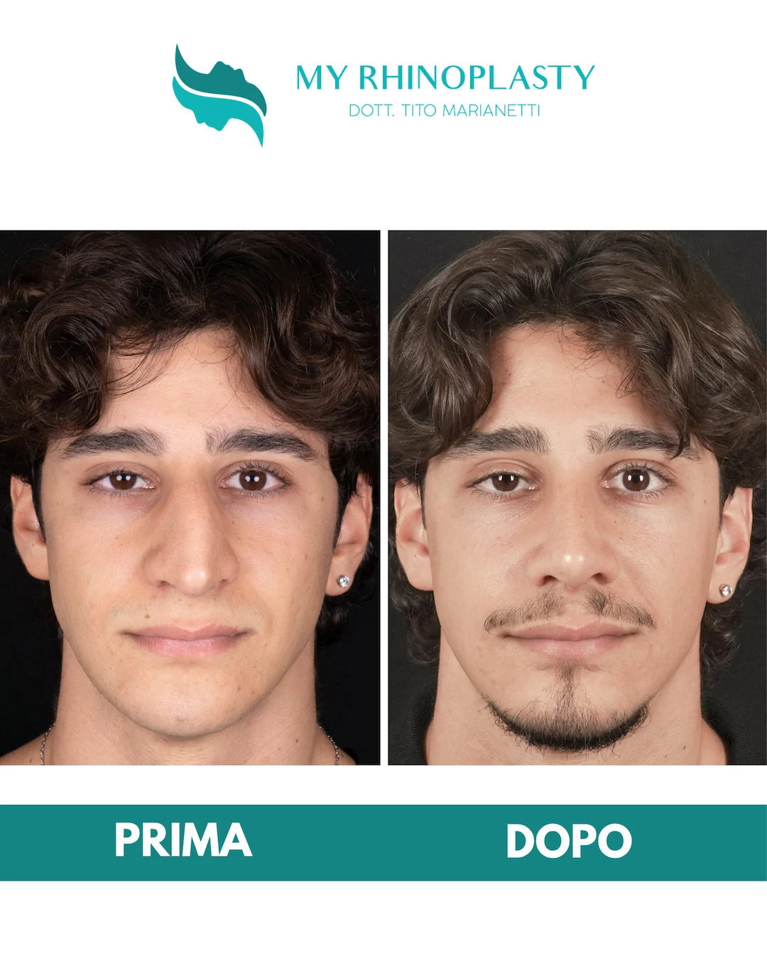 Rinoplastica-primaria 1-Mattia