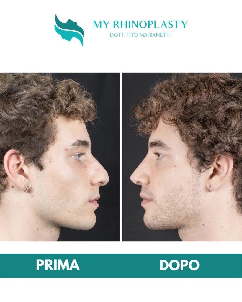 Rinoplastica e rinofiller 07 - rinoplastica primaria, prima e dopo