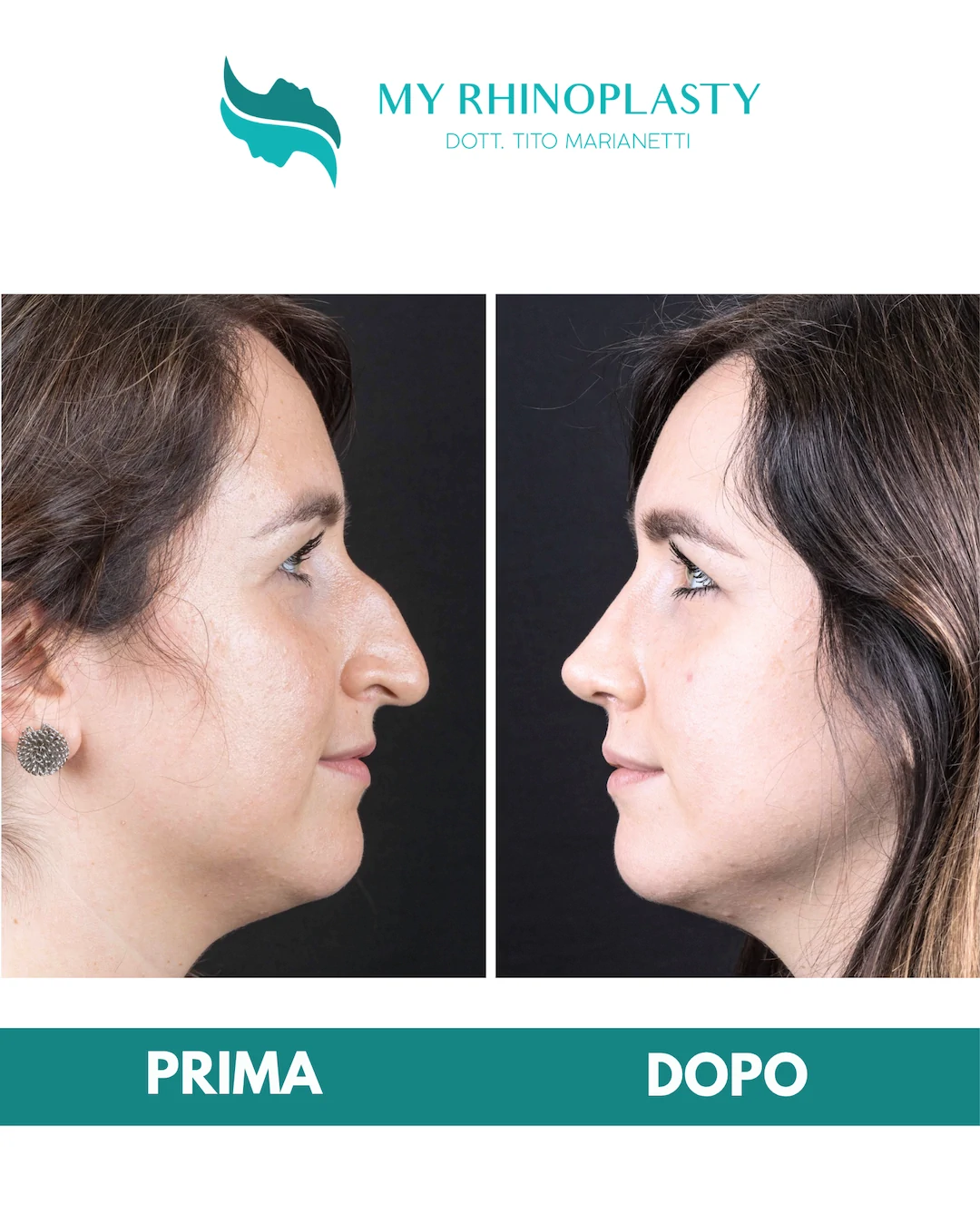 Rinoplastica-primaria 1-Roberta