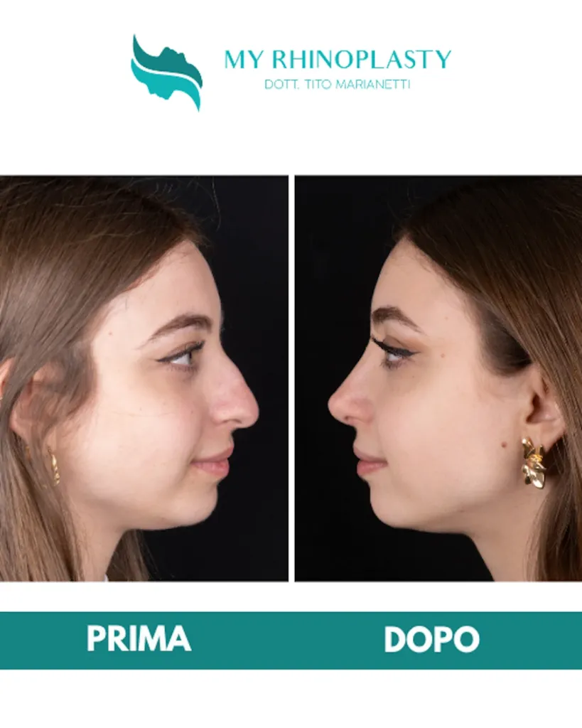 Rinoplastica costo 09 - rinoplastica primaria, prima e dopo