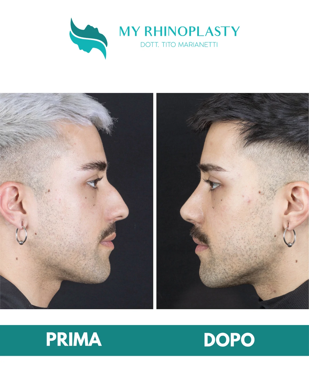 Rinoplastica-primaria 2-Alessandro
