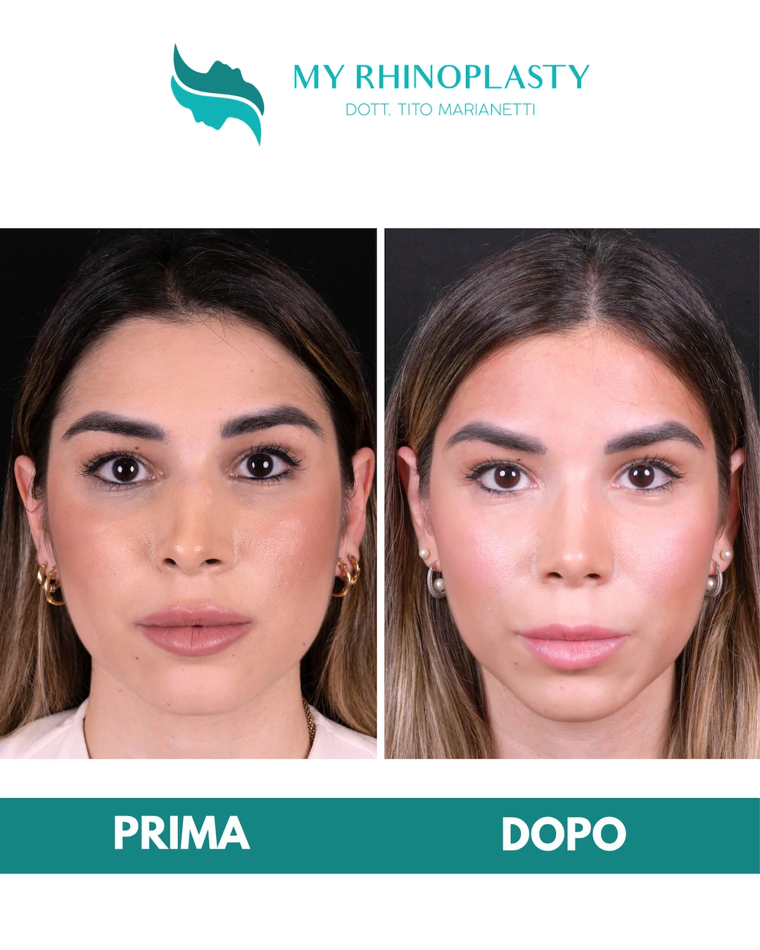 Rinoplastica-primaria 2-Chiara