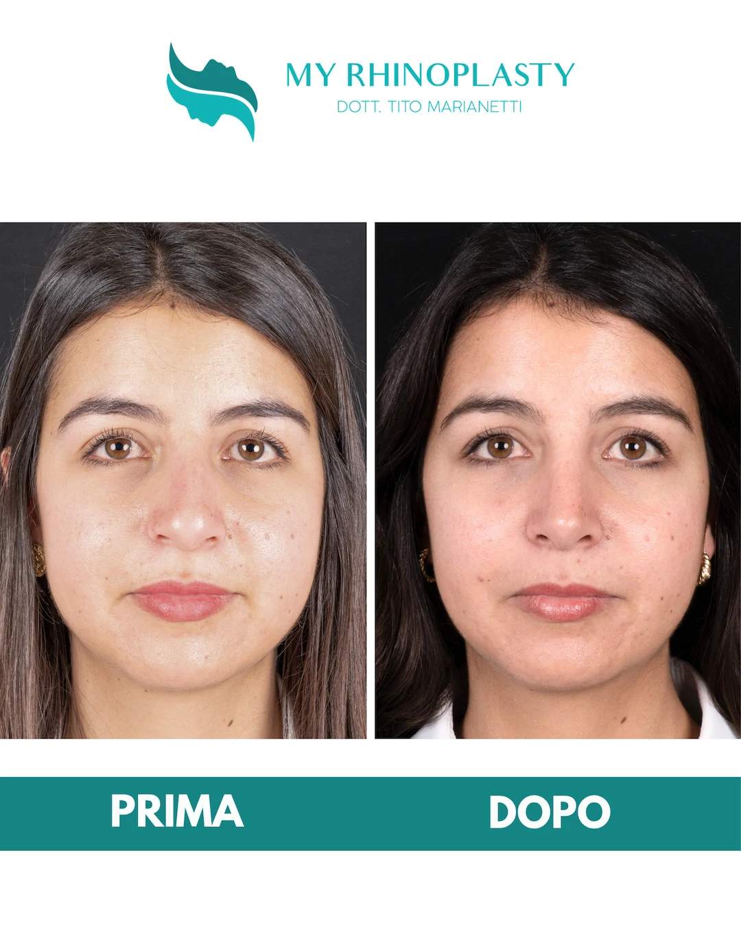 Rinoplastica-primaria 2-Doriana