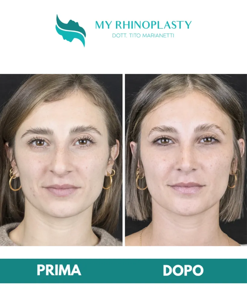 Valvola nasale esterna 15 - rinoplastica primaria, prima e dopo