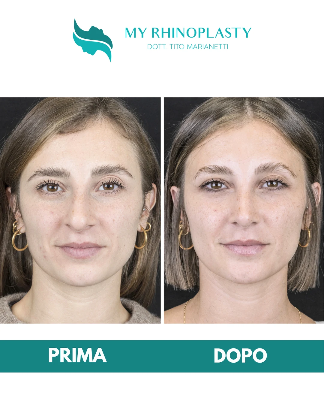 Rinoplastica-primaria 2-Elena F.