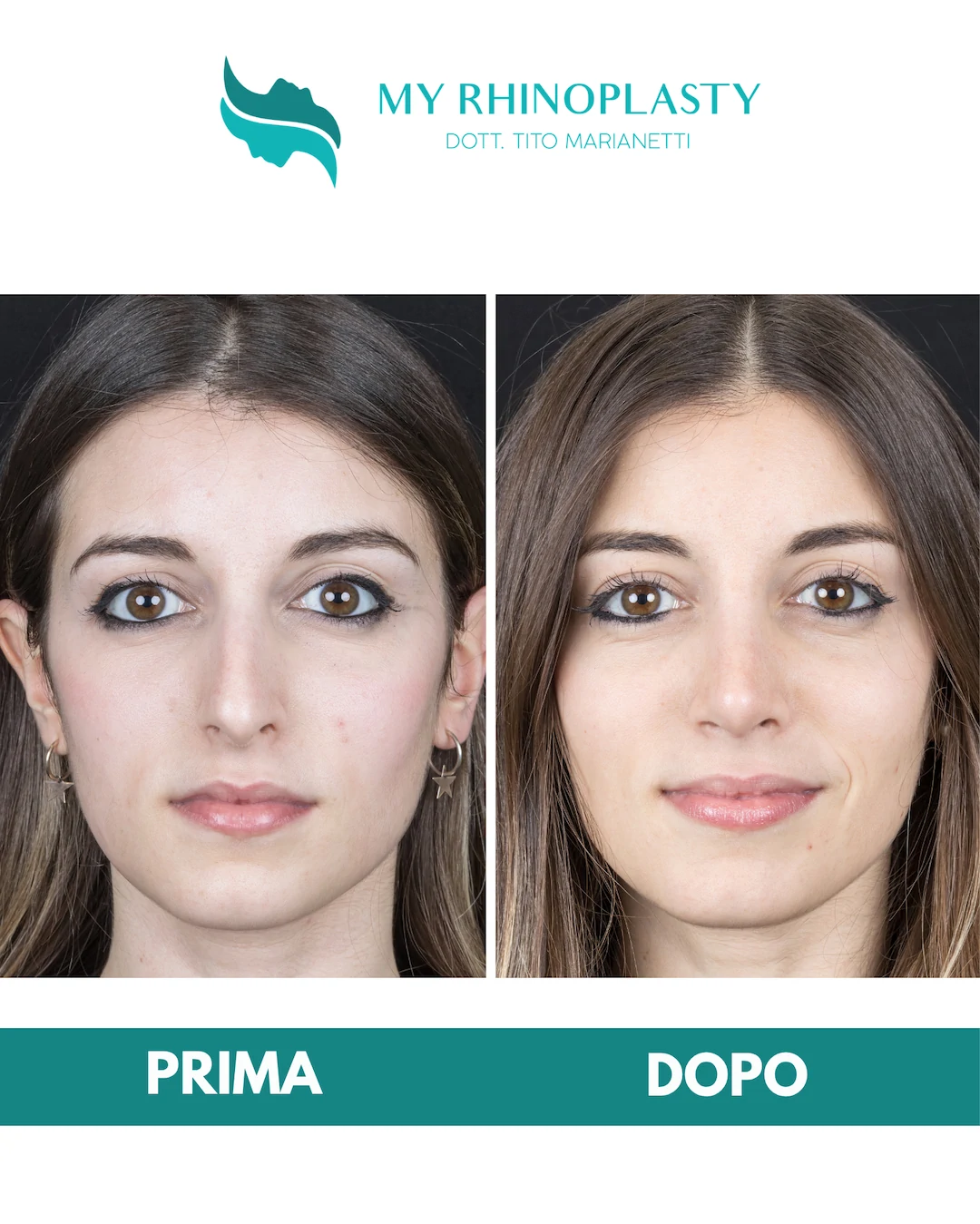 Rinoplastica-primaria 2-Elisa