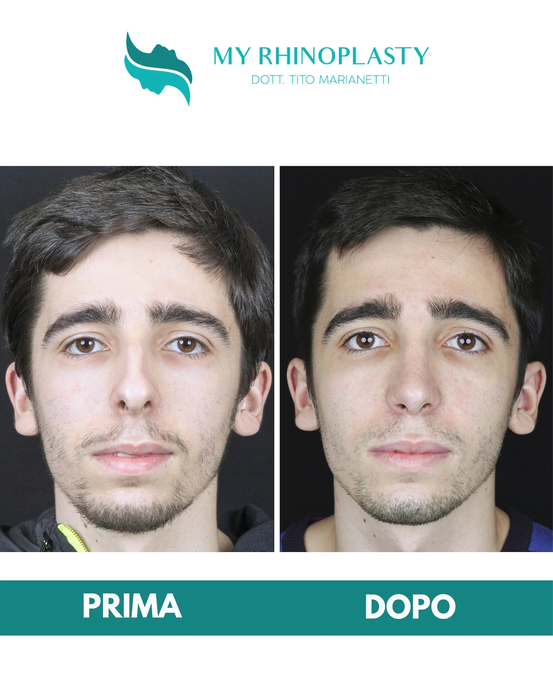 Rinoplastica-primaria 2-Francesco