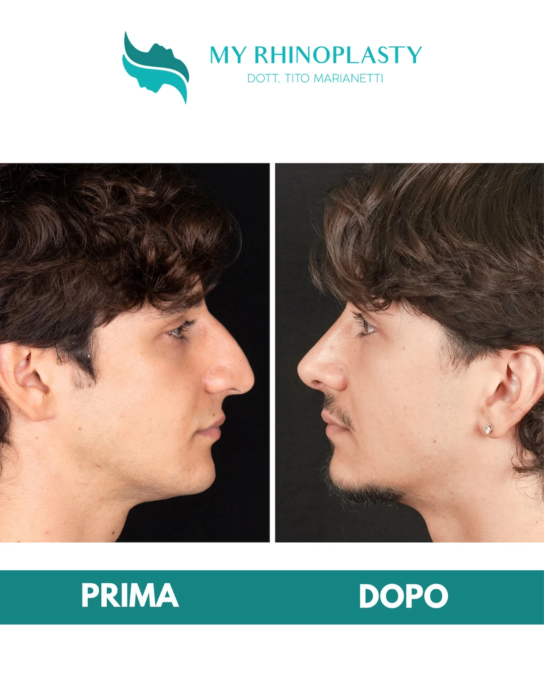 Rinoplastica-primaria 2-Mattia