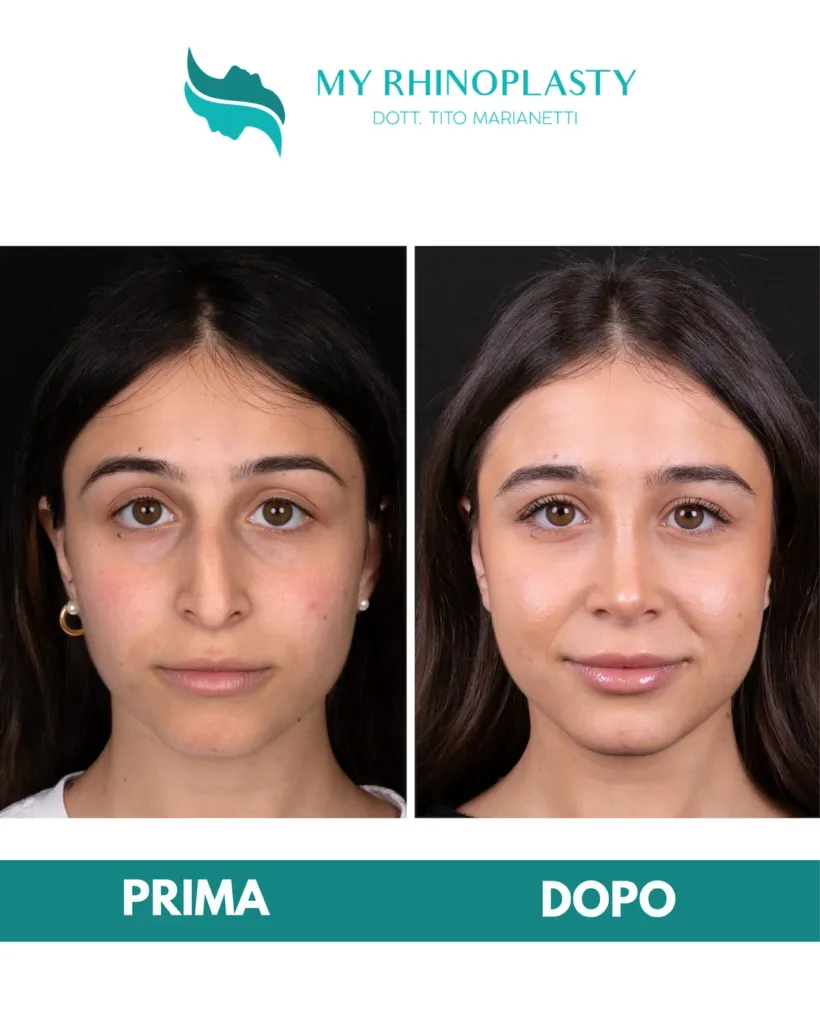 Rinoplastica costo 01 - rinoplastica primaria, prima e dopo