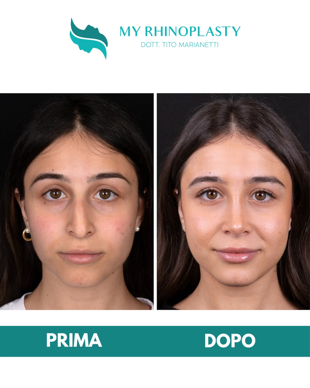 Rinoplastica-primaria 2-Simona