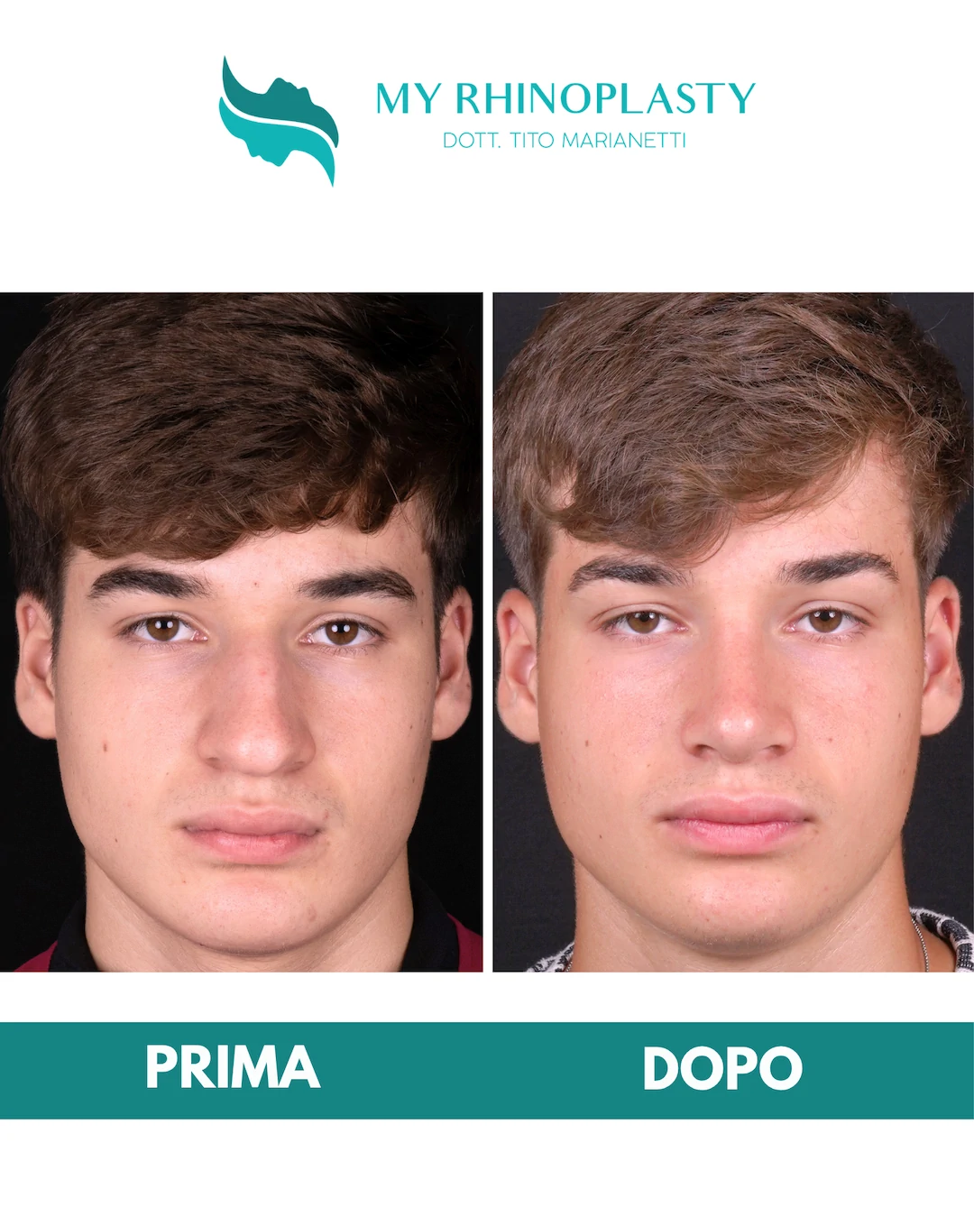 Rinoplastica-primaria 2-Valerio
