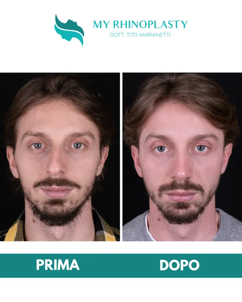 Rinoplastica costo 12 - setto nasale deviato, prima e dopo
