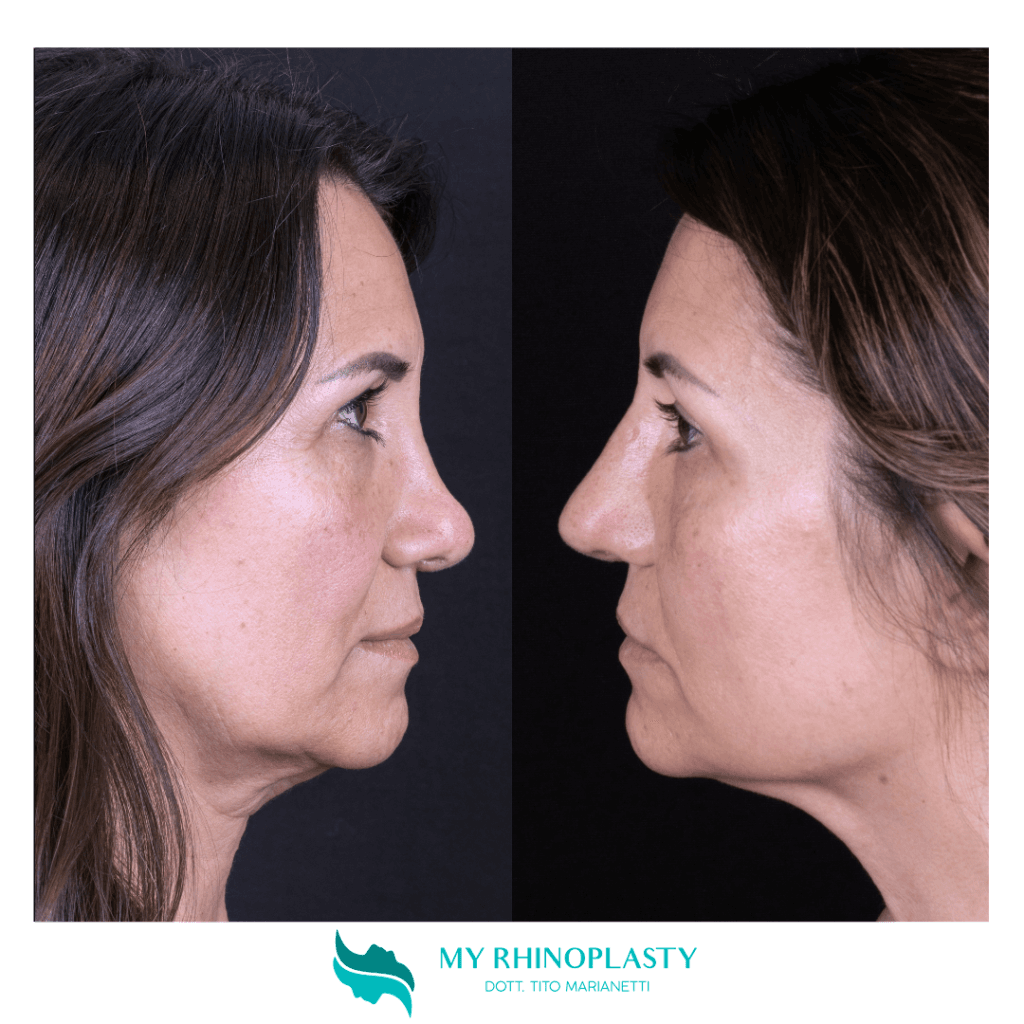 Structural rhinoplaty