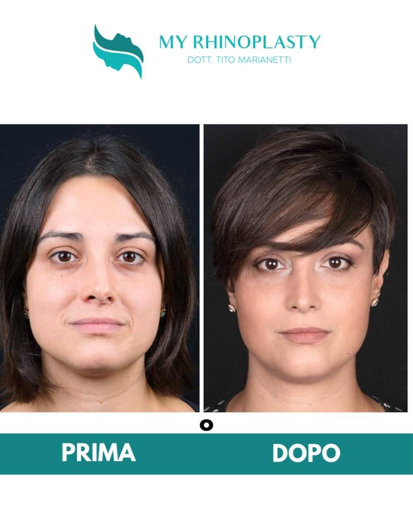 Valvola nasale esterna 03